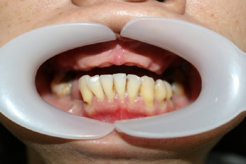 Trồng răng nguyên hàm được áp dụng cho các trường hợp mất răng toàn hàm