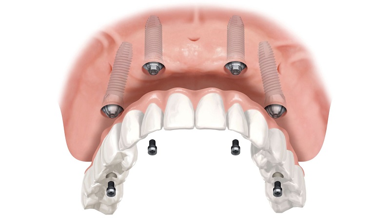 Trồng răng bằng cấy ghép Implant được đánh giá cao hơn so với hàm giả tháo lắp