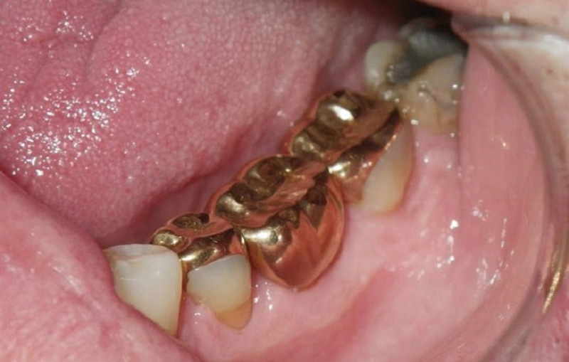 Trồng răng vàng cũng là phương pháp phục hình răng đã mất