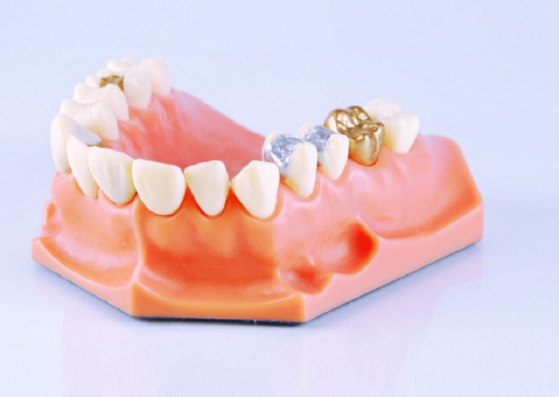 Trồng răng vàng có tồn tại một số nhược điểm, do đó hãy hỏi thật kỹ chuyên gia trước khi thực hiện