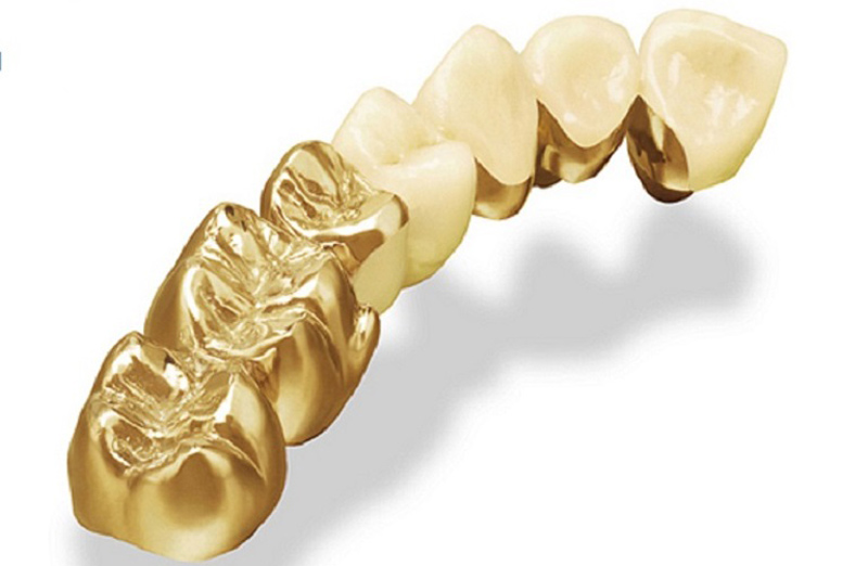 Chi phí trồng răng vàng phụ thuộc vào nhiều yếu tố