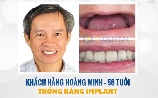 Hình ảnh trước sau khi trồng răng Implant của khách hàng Hoàng Minh - 58 Tuổi 