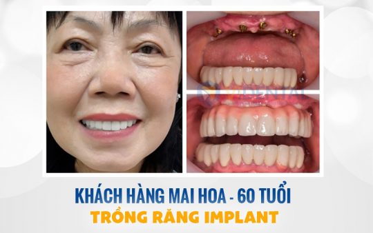 Hình ảnh trước và sau khi trồng răng Implant của khách hàng Mai Hoa - 60 Tuổi