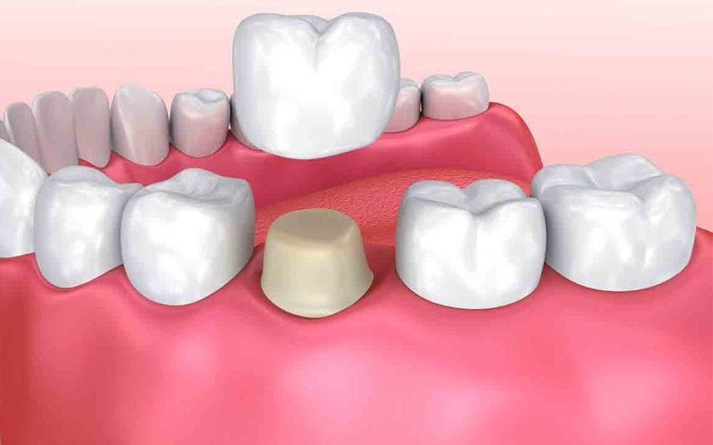 Bọc răng sứ bị cộm do nhiều nguyên nhân gây ra