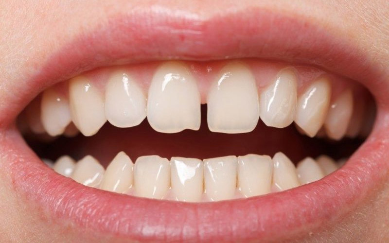 Phương pháp bọc răng sứ Nano Shining 5s phù hợp với hàm răng thưa