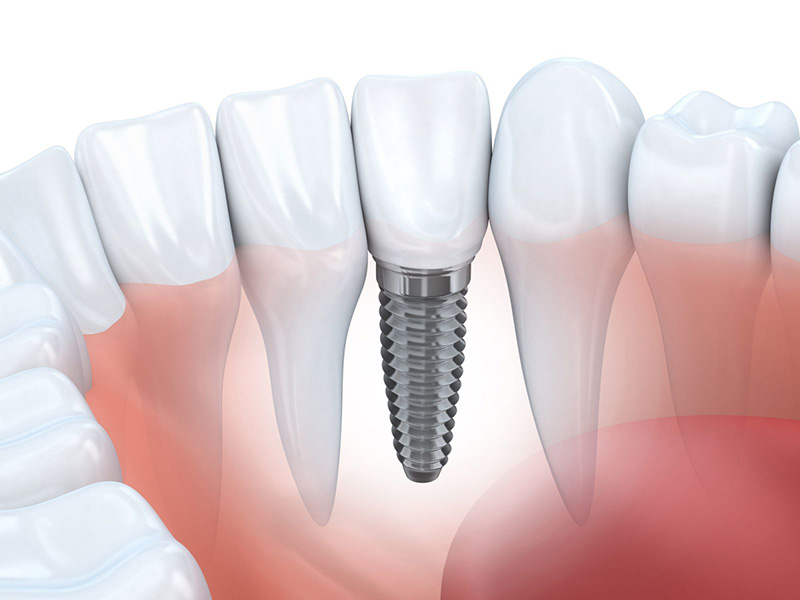 Giá trồng răng implant hiện nay như thế nào được nhiều người quan tâm
