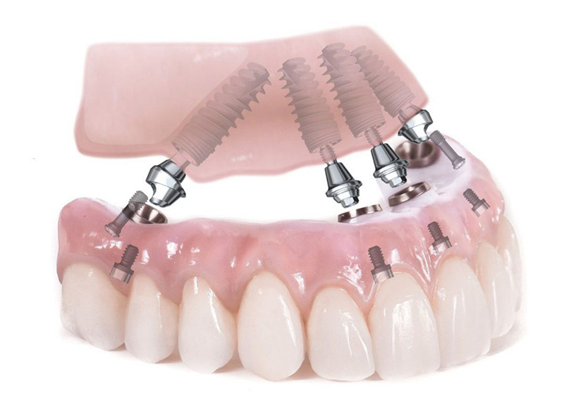 Giá trồng răng implant toàn hàm khác nhau tùy chất liệu trụ