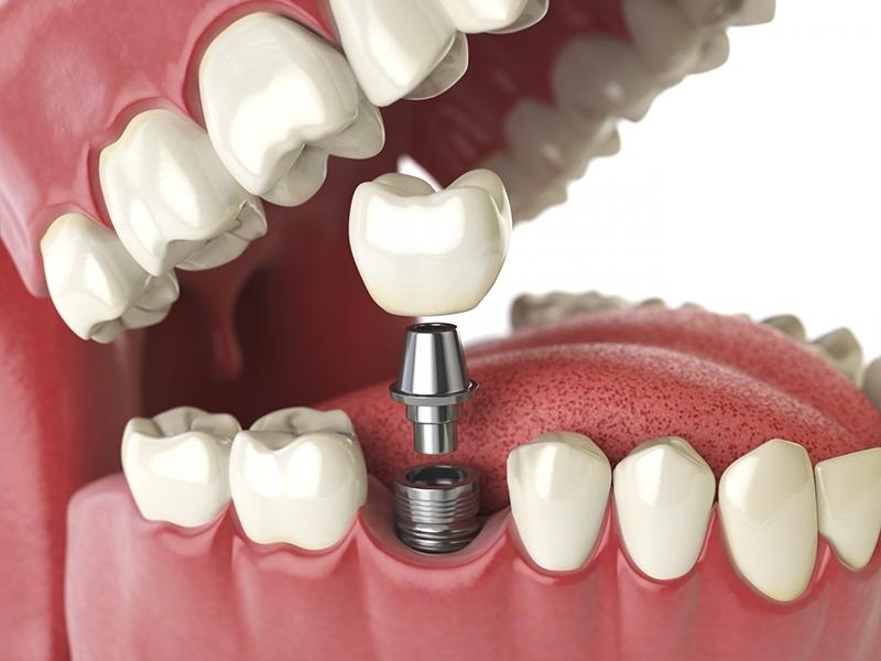 Giá cấy ghép răng Implant sẽ có sự khác biệt đáng kể ở từng cơ sở nha khoa