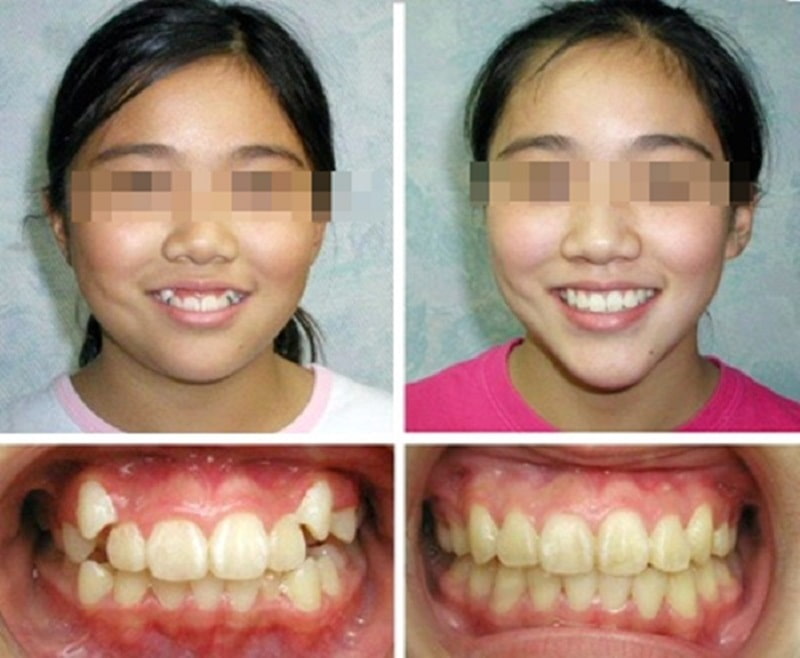 Niềng răng thay đổi hoàn toàn khuôn mặt