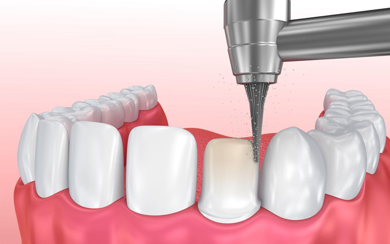 Trong một số trường hợp mài răng có thể tác động trực tiếp đến tủy răng