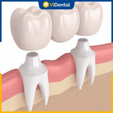 Sử dụng cầu răng sứ cho trường hợp mất nhiều răng