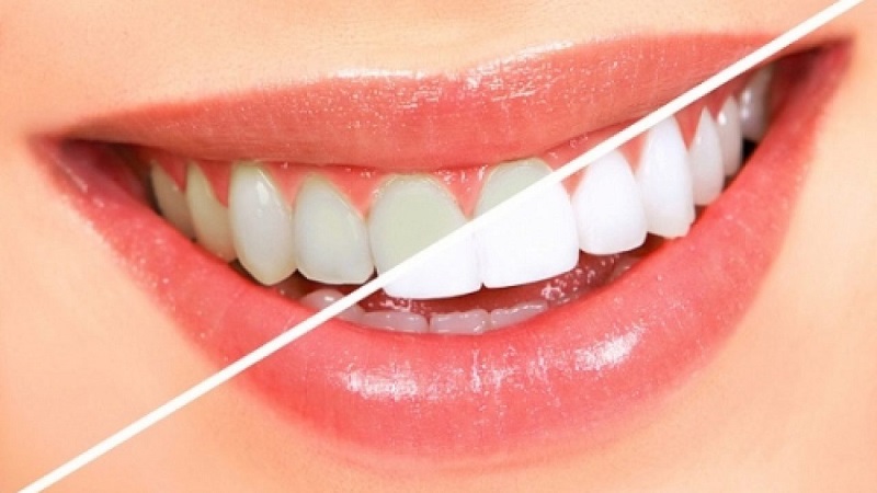 Tẩy trắng răng giúp răng trở nên trắng sáng, đều màu hơn