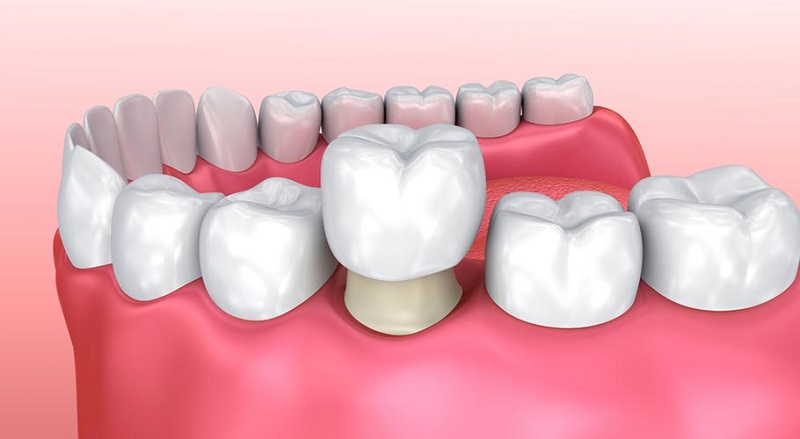 Răng đã bọc sứ không thể làm trắng bằng các cách thông thường