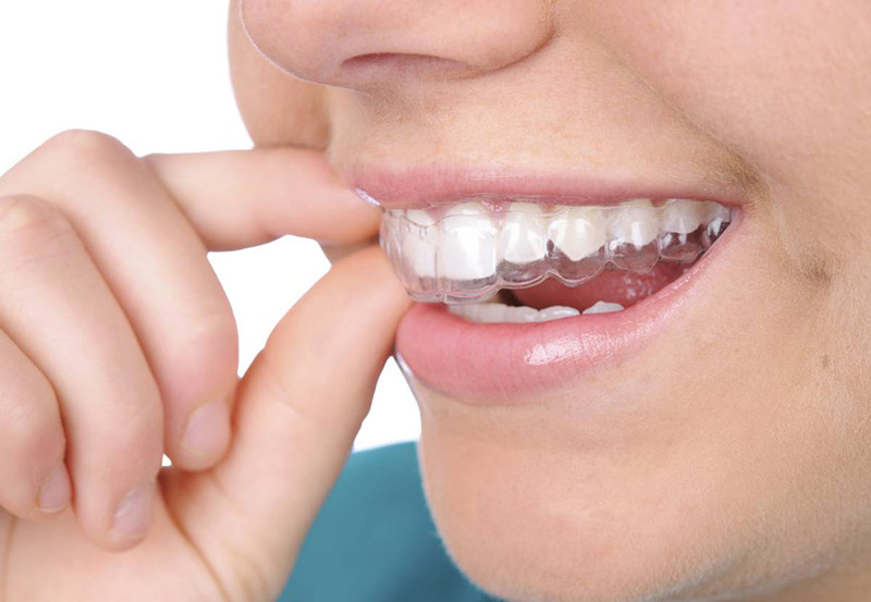Tẩy trắng răng bằng máng tại nhà có sự kết hợp cùng thuốc làm trắng răng