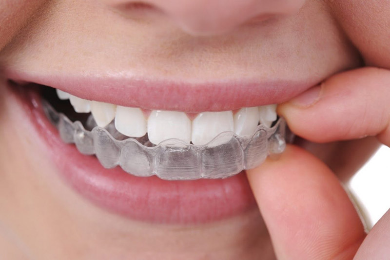 Phương pháp này có nhiều ưu điểm và an toàn với sức khỏe răng miệng