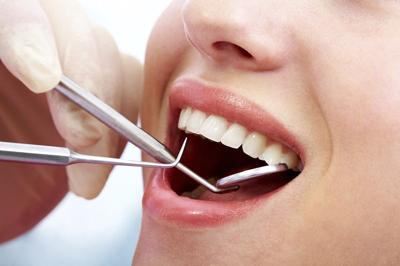 Tẩy trắng răng được bao lâu còn phụ thuộc vào phương pháp thực hiện