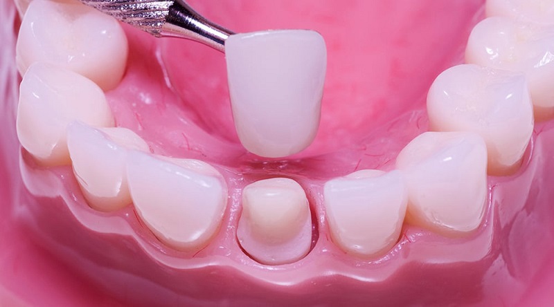 Người có răng đã bọc sứ không nên dùng thuốc tẩy trắng răng