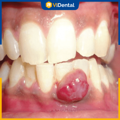 Chảy máu chân răng, sưng nướu răng quanh khu vực trồng răng là biến chứng phổ biến