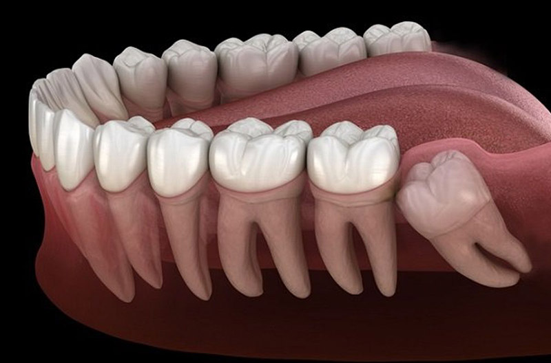 Không trồng răng cấm sẽ gây ra nhiều ảnh hưởng đến thẩm mỹ, sức khỏe