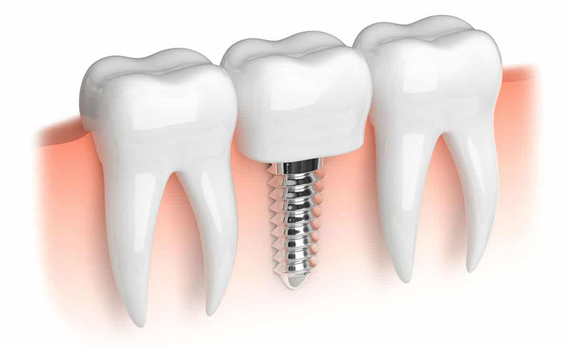 Trồng răng cấm cố định bằng implant là kỹ thuật hiện đại nhất hiện nay
