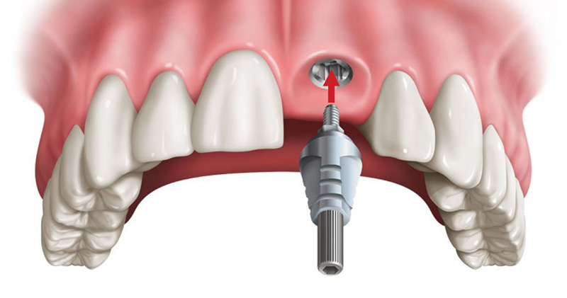 Trồng răng cửa có đau không phụ thuộc vào rất nhiều yếu tố