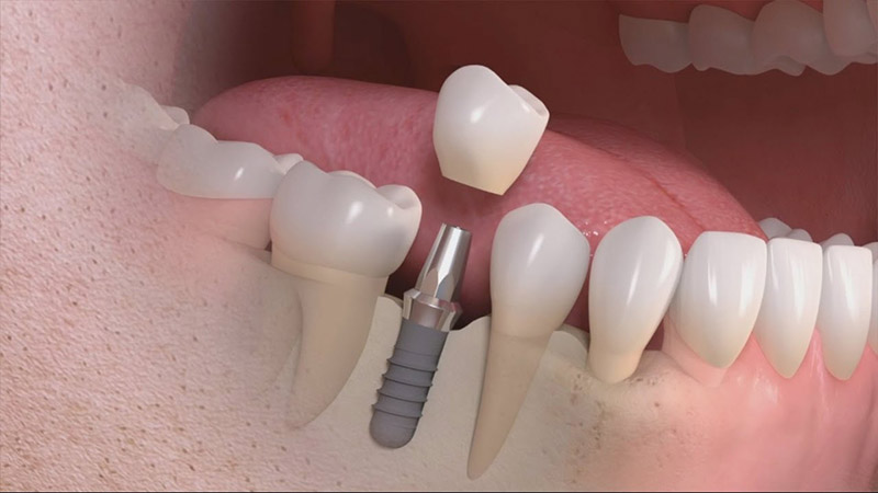 Cấy ghép implant có tác động đến nướu răng nên sẽ gây đau nhức