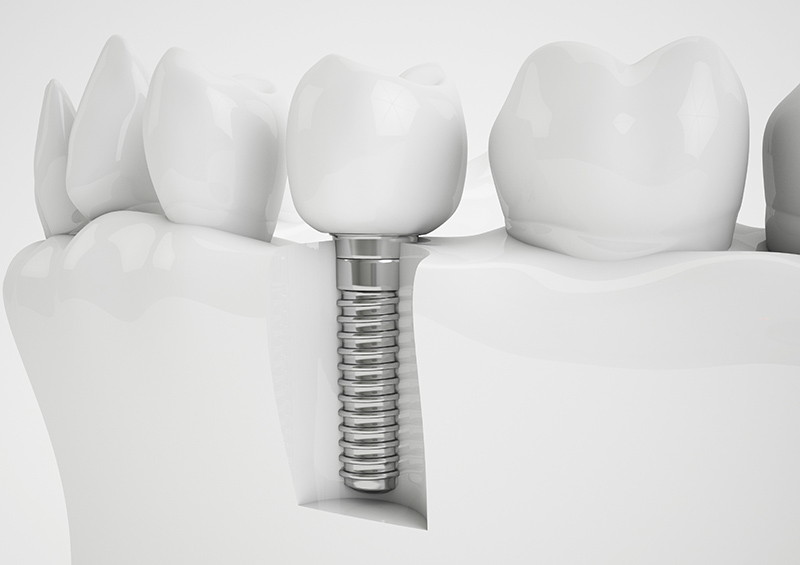 Trồng răng hàm giá bao nhiêu bằng implant còn phụ thuộc vào loại trụ