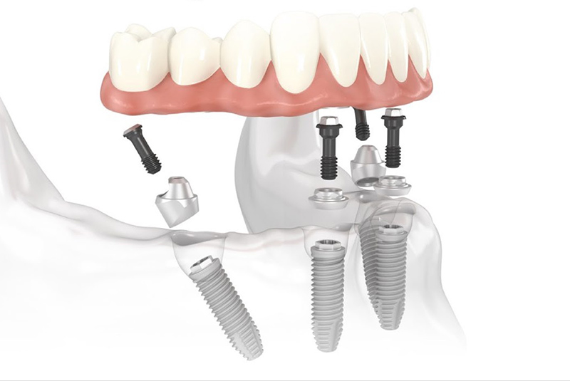 Trồng răng implant giá rẻ tiềm ẩn nhiều rủi ro