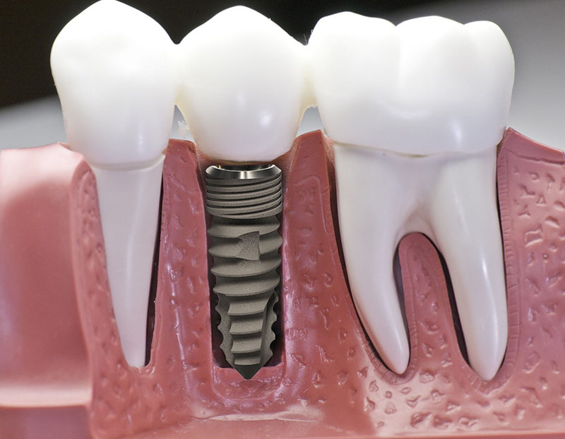 Biến chứng trồng răng implant giá rẻ có thể kéo dài, ảnh hưởng đến sức khỏe