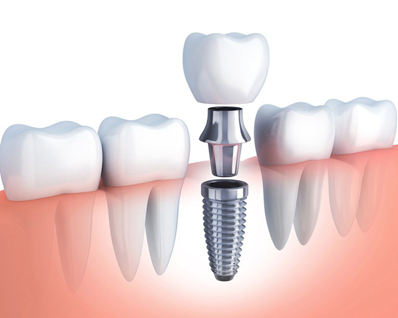 Trồng răng khểnh giá bao nhiêu bằng phương pháp implant?