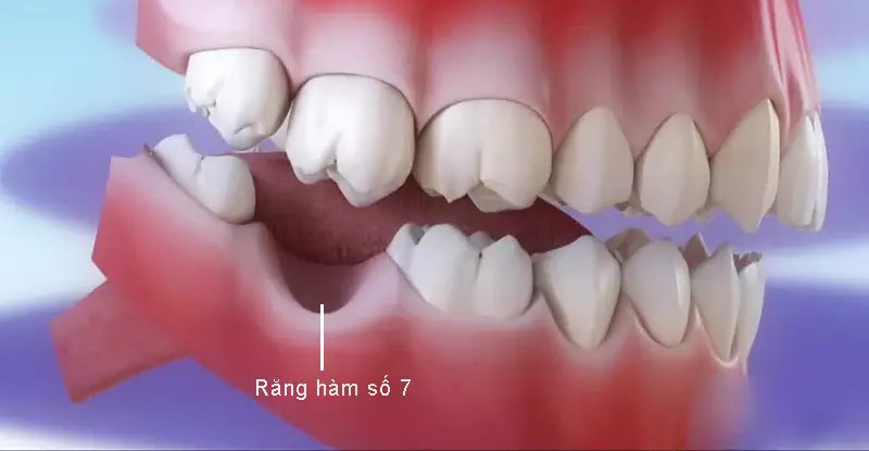 Răng số 7 nằm giữa răng khôn và răng hàm số 6