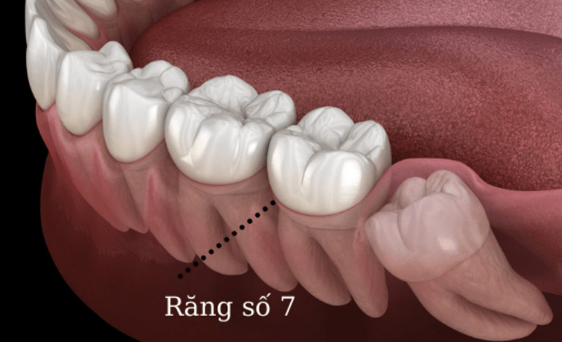 Trồng răng số 7 giúp khôi phục tính thẩm mỹ và chức năng ai nhai