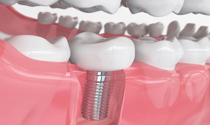 Trồng răng số 7 bằng implant là kỹ thuật hiện đại, nhiều ưu điểm