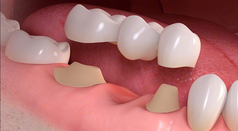 Cầu răng sứ giá cả phải chăng nhưng không thể sử dụng vĩnh viễn như implant