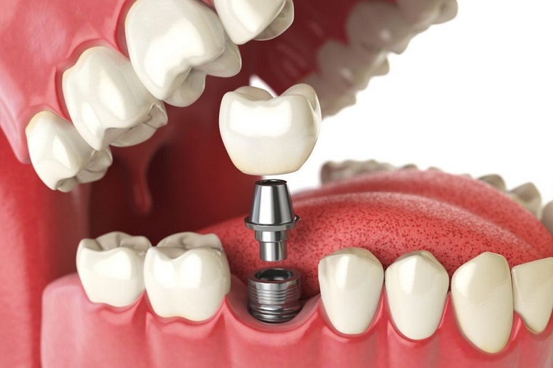 Quy trình trồng răng số 7 bằng implant sẽ trải qua 5 bước chính