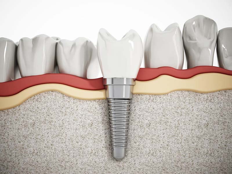 Trồng răng số 7 có lâu không phụ thuộc rất nhiều vào phương pháp mà bạn lựa chọn