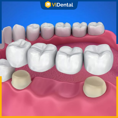 Trồng răng sứ bắc cầu dành cho người mất ít răng