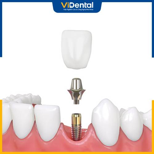 Giá trồng răng Implant cao nhưng mang đến hiệu quả tốt, bền vững