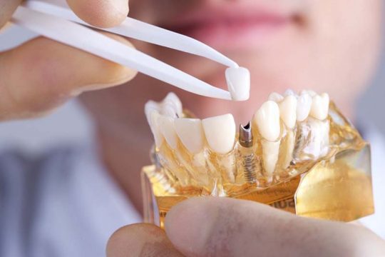 [Cập Nhật Mới Nhất] Bảng Giá Trồng Răng Implant Chất Lượng Cao