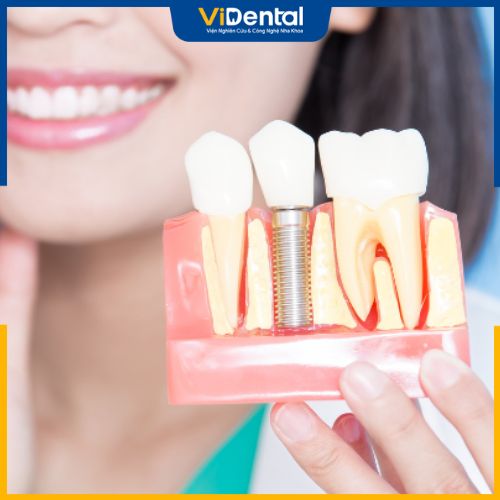Giá trồng răng Implant tương đối cao do sở hữu nhiều ưu điểm vượt trội