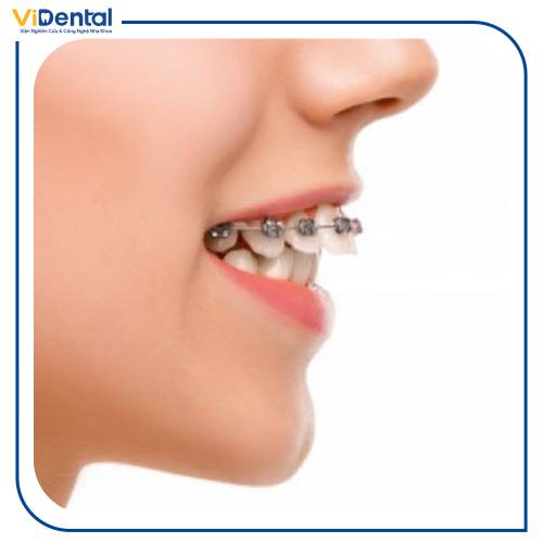 Tình trạng và mức độ sai lệch của hàm răng là 1 trong những yếu tố quyết định đến giá niềng răng 1 hàm