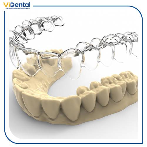 Niềng răng 3D Clear dùng các khay niềng trong suốt có thể tháo lắp để nắn chỉnh răng về vị trí đúng trên cung hàm