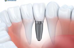 Review Trồng Răng Implant Chi Tiết: Có Đau Không, Độ Bền Ra Sao?
