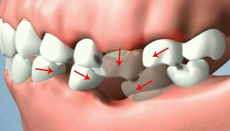 Các chuyên gia khuyến nghị nên trồng răng hàm dưới bị mất càng sớm càng tốt