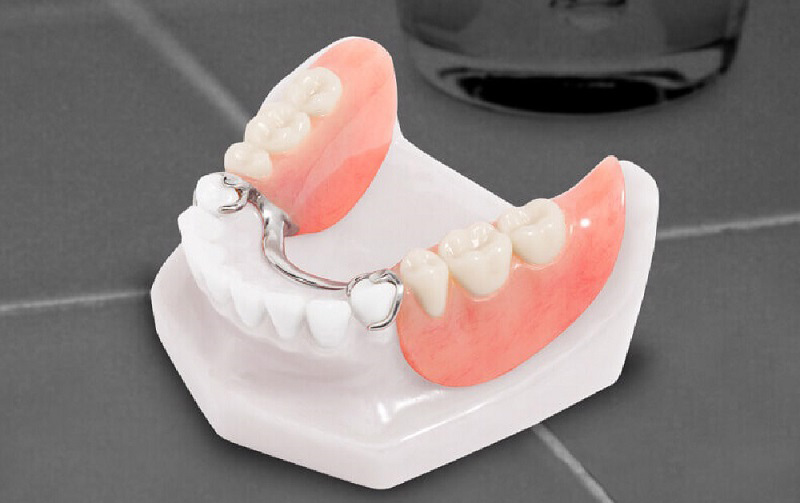 Trồng răng giả tháo lắp cho hàm dưới được nhiều người lựa chọn