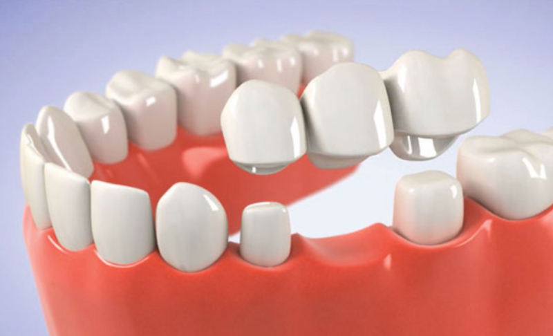 Cầu răng sứ giúp trồng răng hàm dưới cố định có tính thẩm mỹ cao