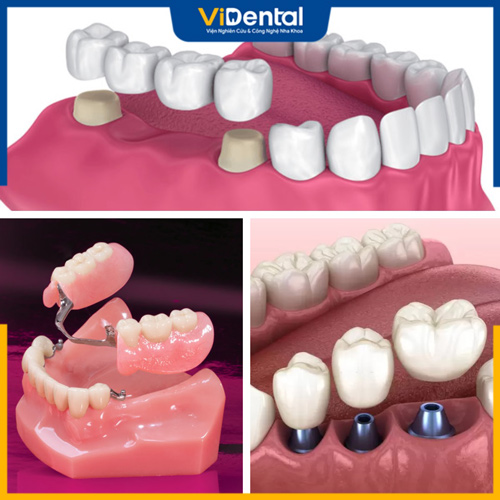 3 phương pháp trồng răng hàm có mức giá khác nhau