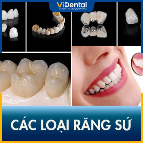 Mỗi loại răng sứ làm cầu răng hàm sẽ có giá khác nhau