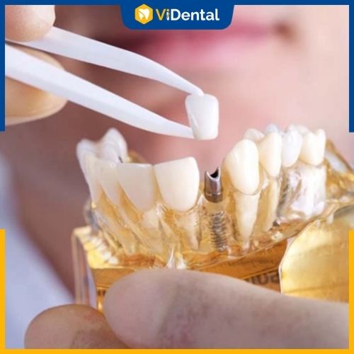 Bảng giá trồng răng Implant phụ thuộc nhiều vào nhiều yếu tố khác nhau