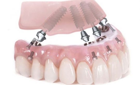 Trồng Răng Implant All On 4: Ưu - Nhược Điểm, Quy Trình, Chi Phí